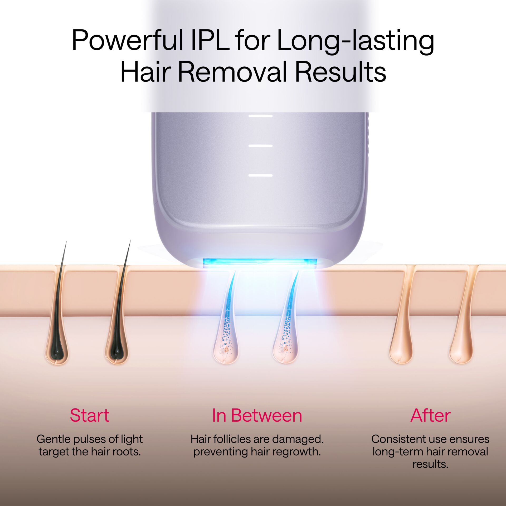 IPL-Gerät, Haarentfernung, Laser, blaues Licht, hautfreundlich